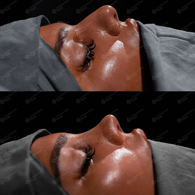 What Is Ethnic Rhinoplasty