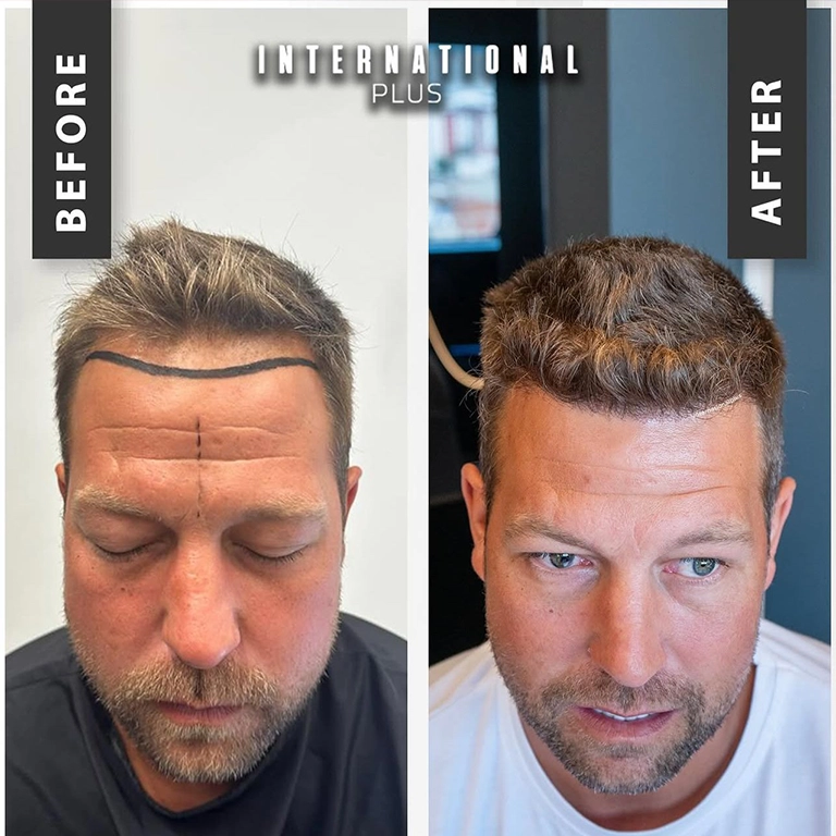 Which Is Better DHI or FUE