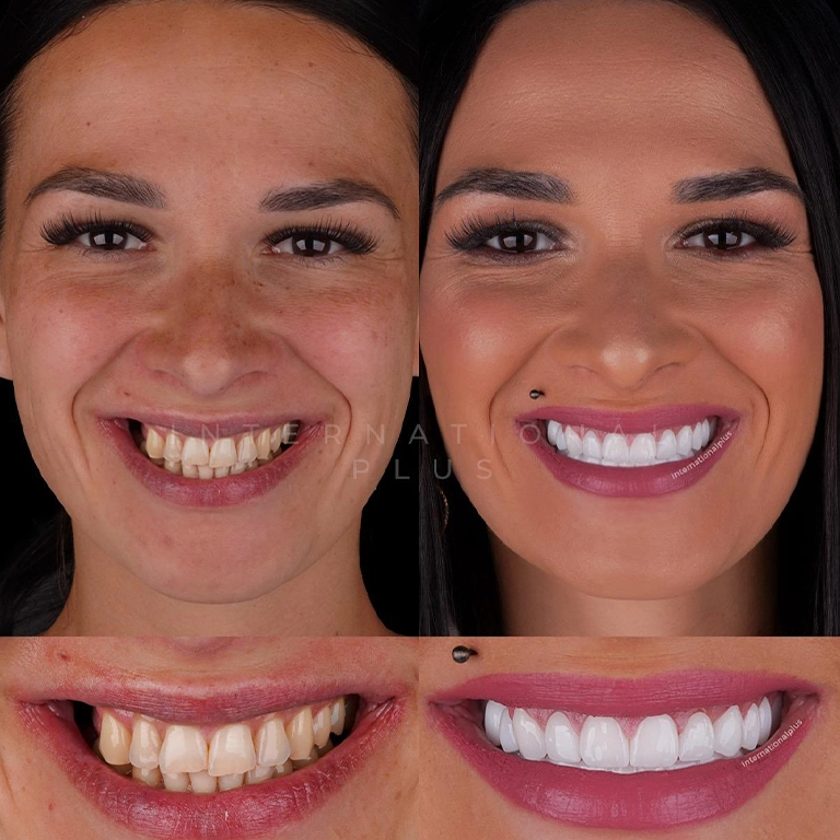 Which Is Better For Molars