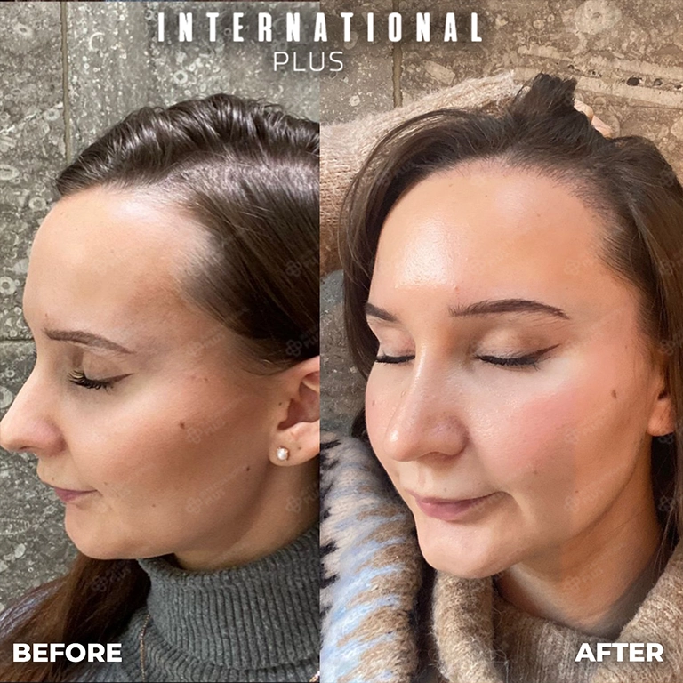 Women Hair Loss Causes