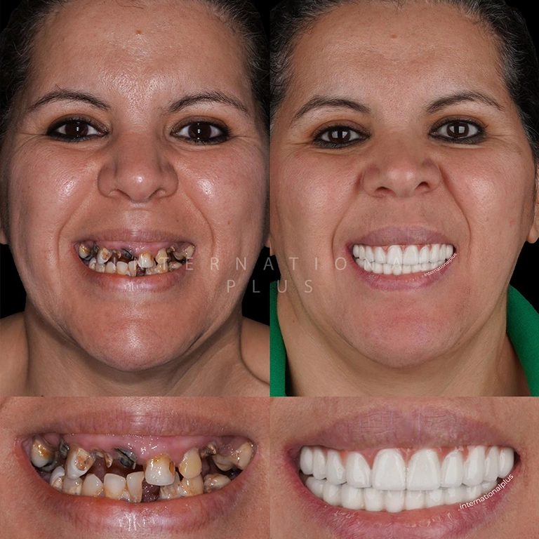 Zirconia Crowns Price 2026