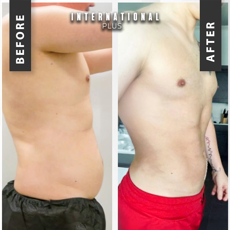 Chin and Jawline Implants For Men