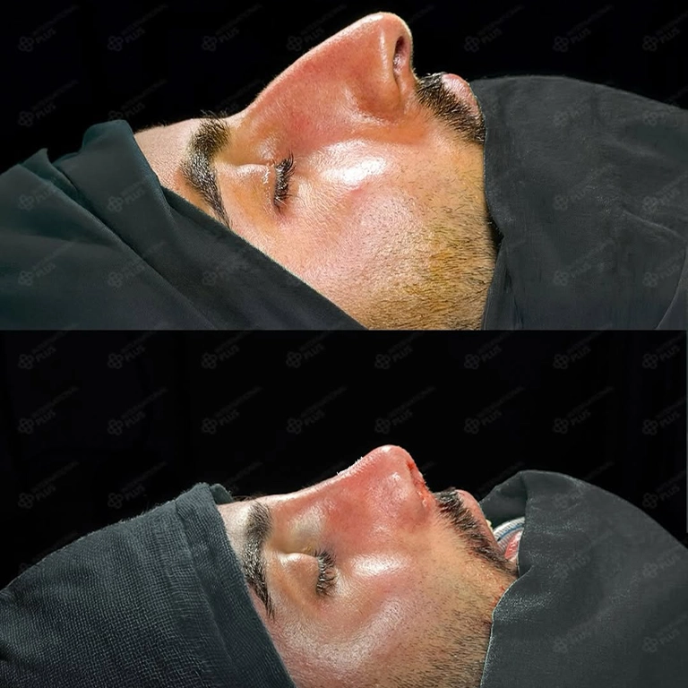 Gynecomastia and Tummy Tuck Combo