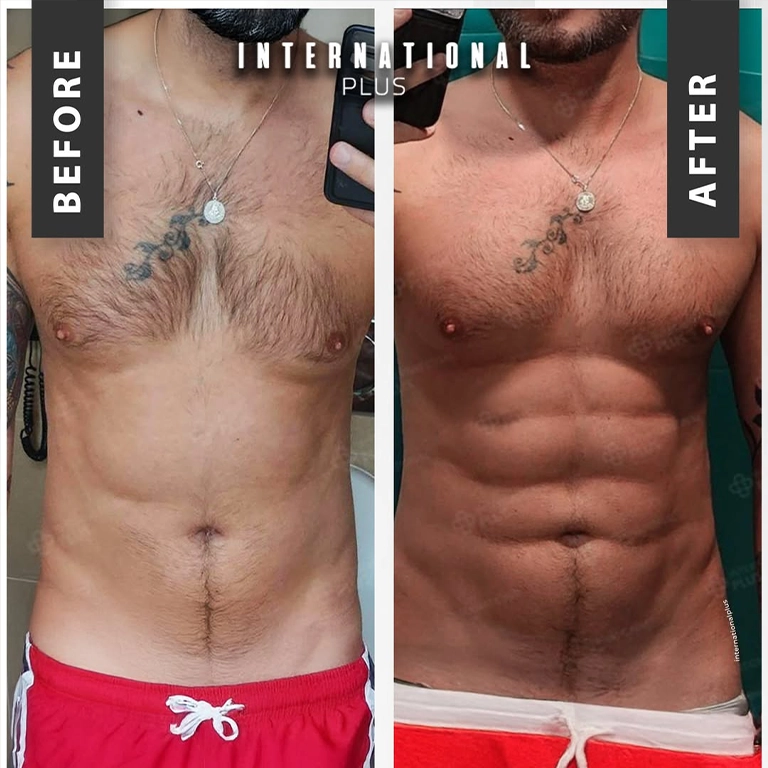 Male Liposuction and Six Pack