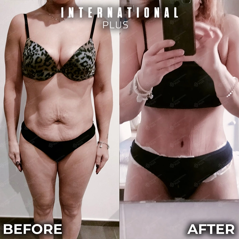 Mommy Makeover Recovery Timeline