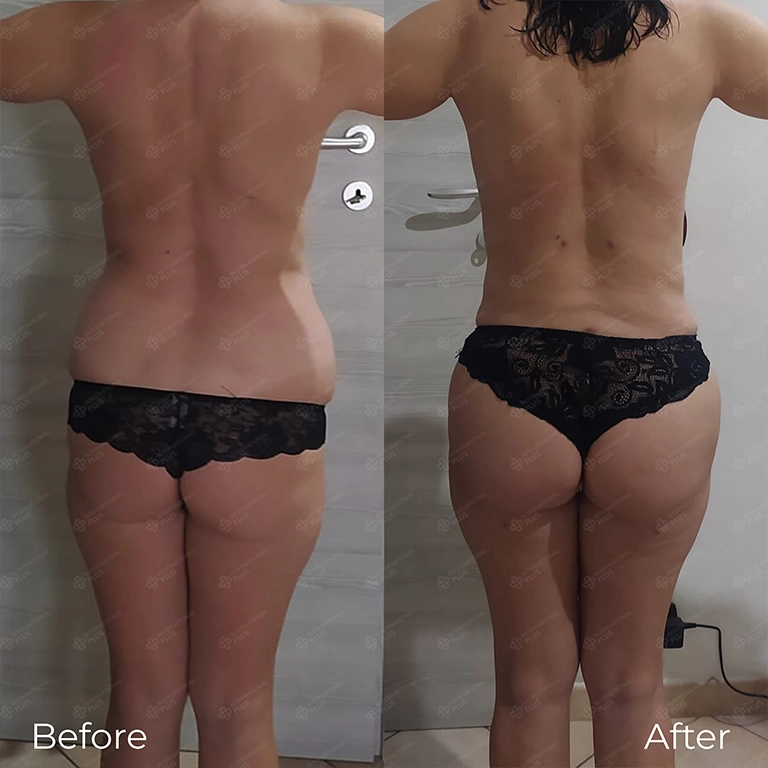 Sleeping Positions After Mommy Makeover