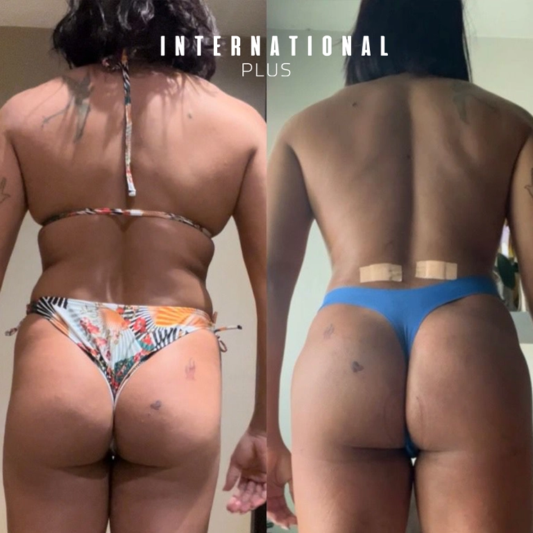 Wearing Compression Garments