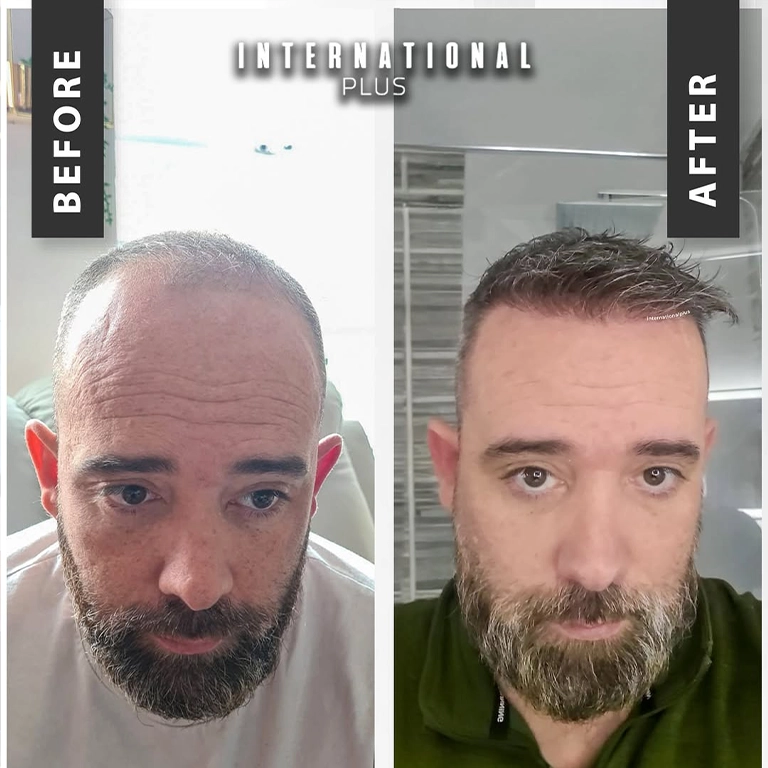 What Is Stem Cell Therapy For Hair