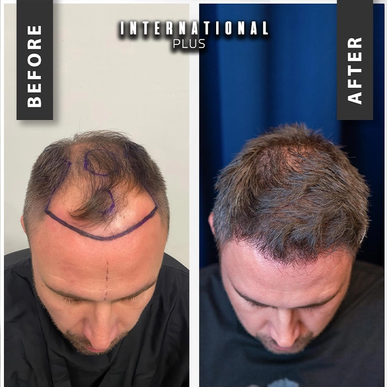 Who Is A Candidate For Stem Cell