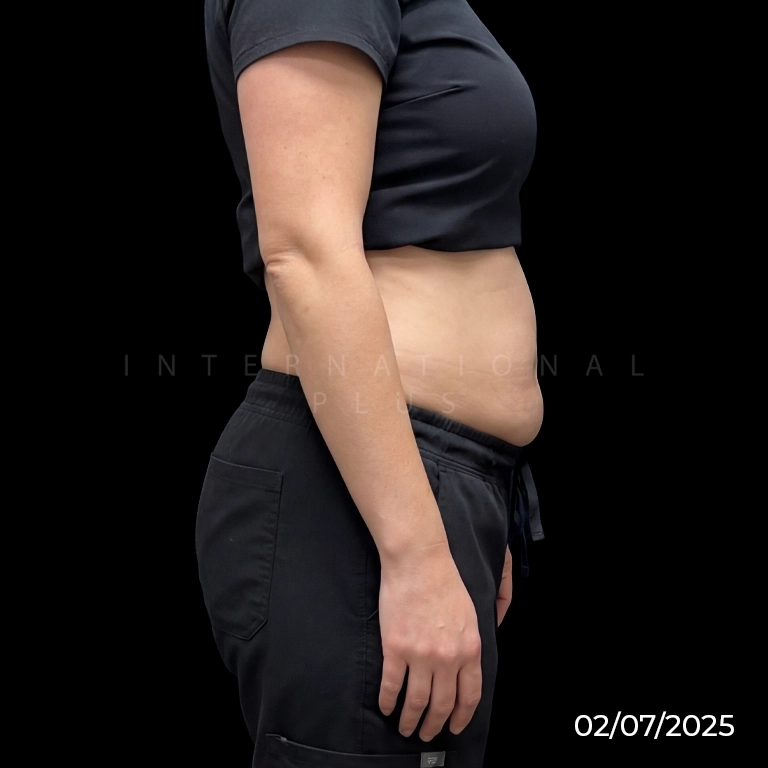 Best Areas for J-Plasma Neck, Arms, and Abdomen