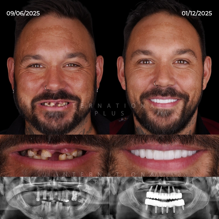 Day 1 to Day 7 Dental Implant Post-Op Guide