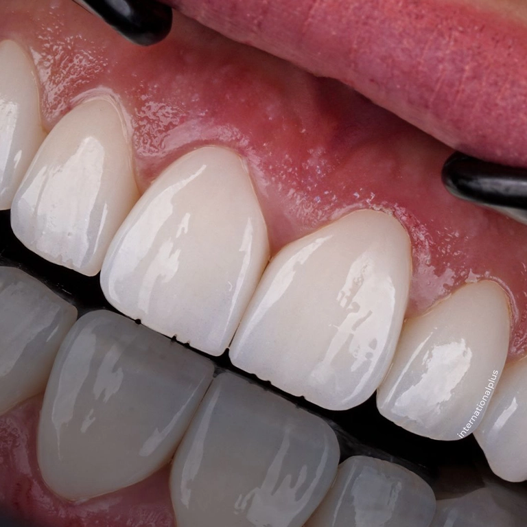 Dental Implant Complications and Risks