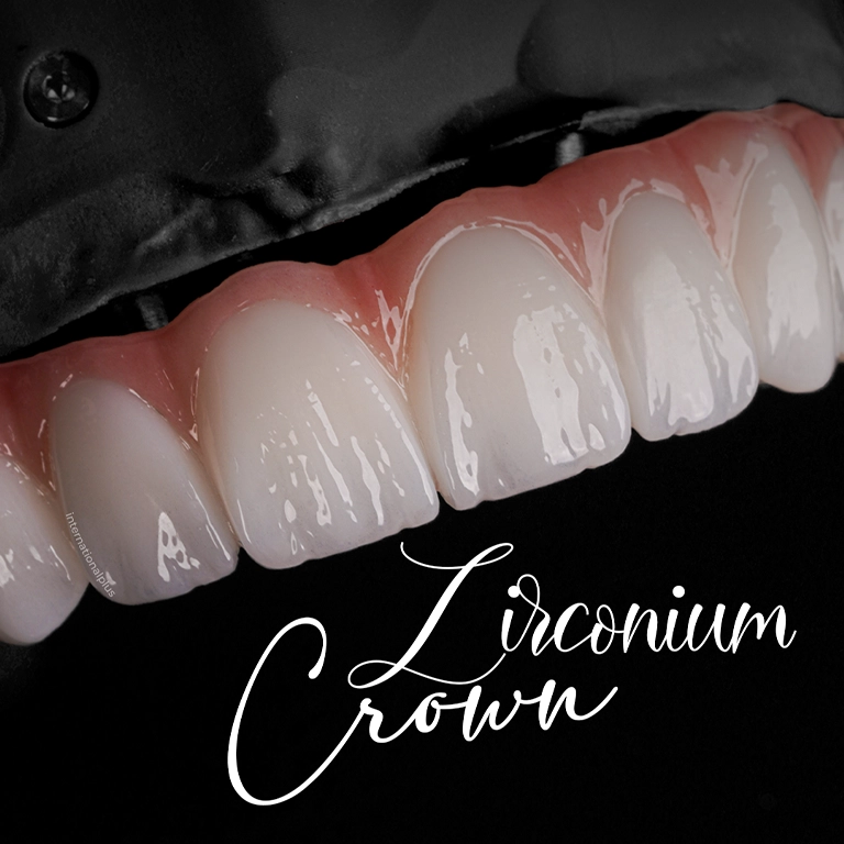 Dental Implant Long-Term Success Strategies