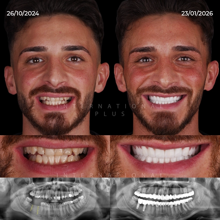 Dental Implants Turkey