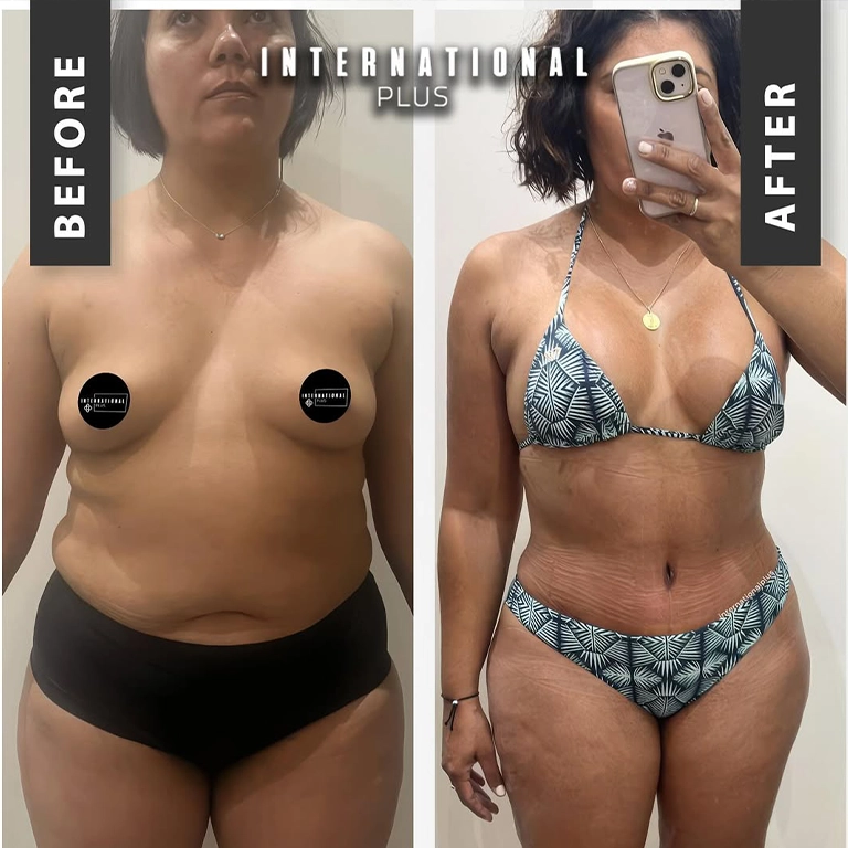 Diastasis Recti Repair and Core Architecture