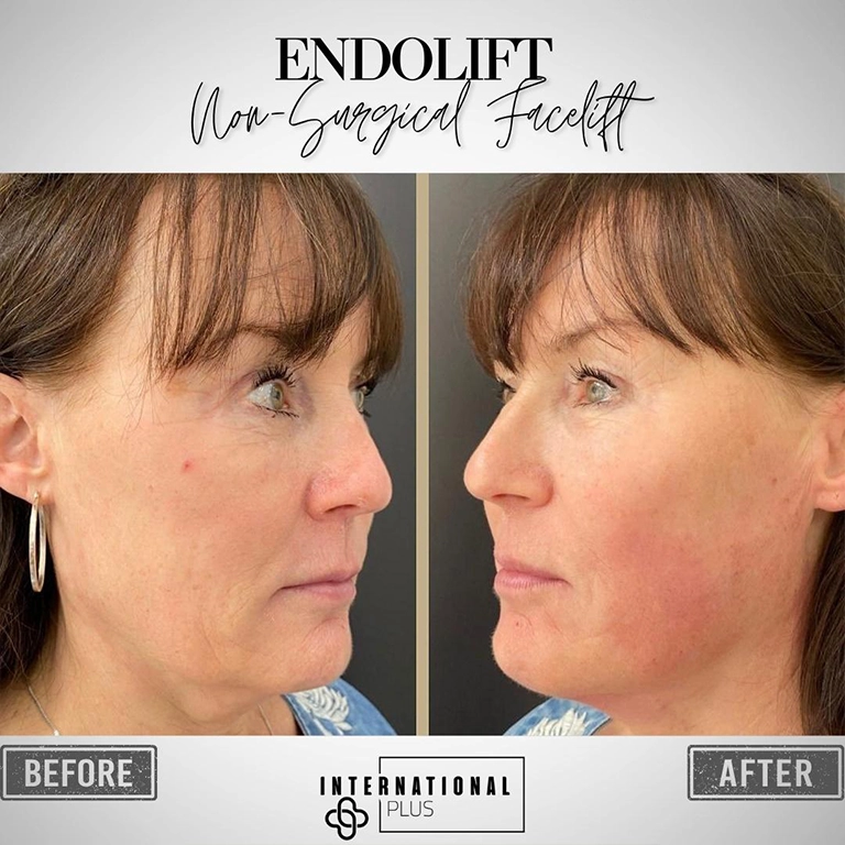 Endolift vs. Traditional Facelift Recovery Comparison