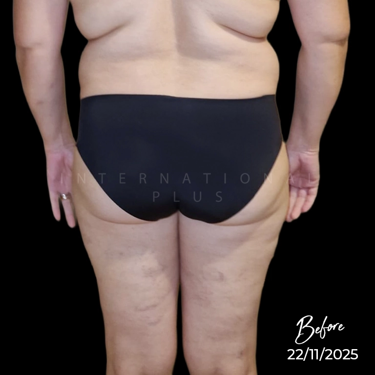 Feeding the Fat Best Diet for BBL Recovery