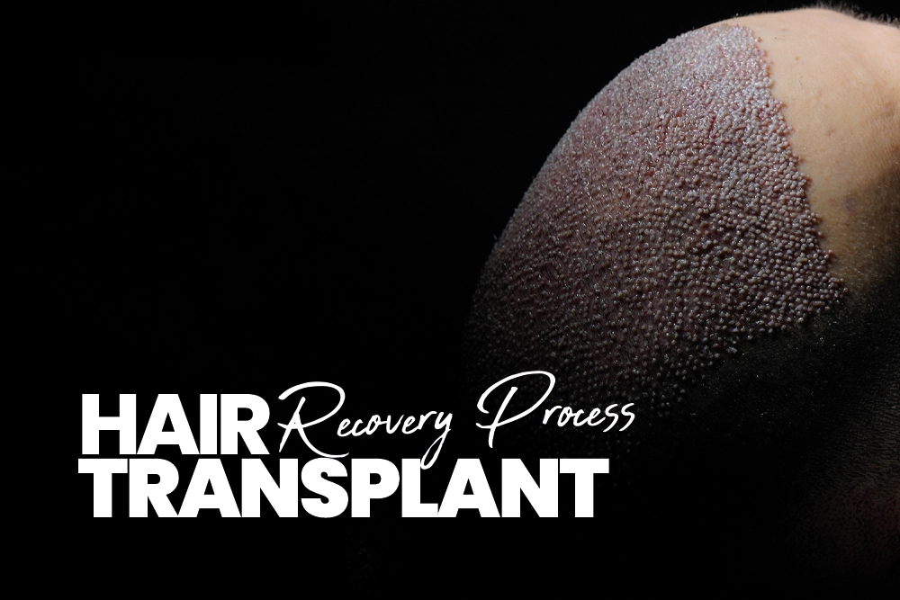 Hair Transplant Recovery Process