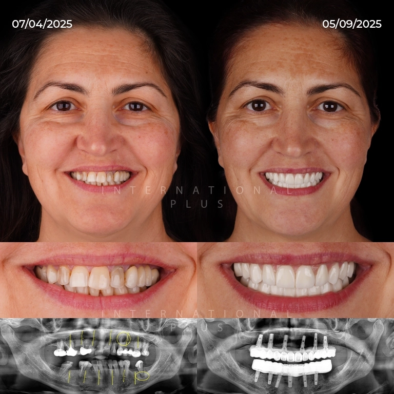 How Long Does Pain Last After Dental Implant