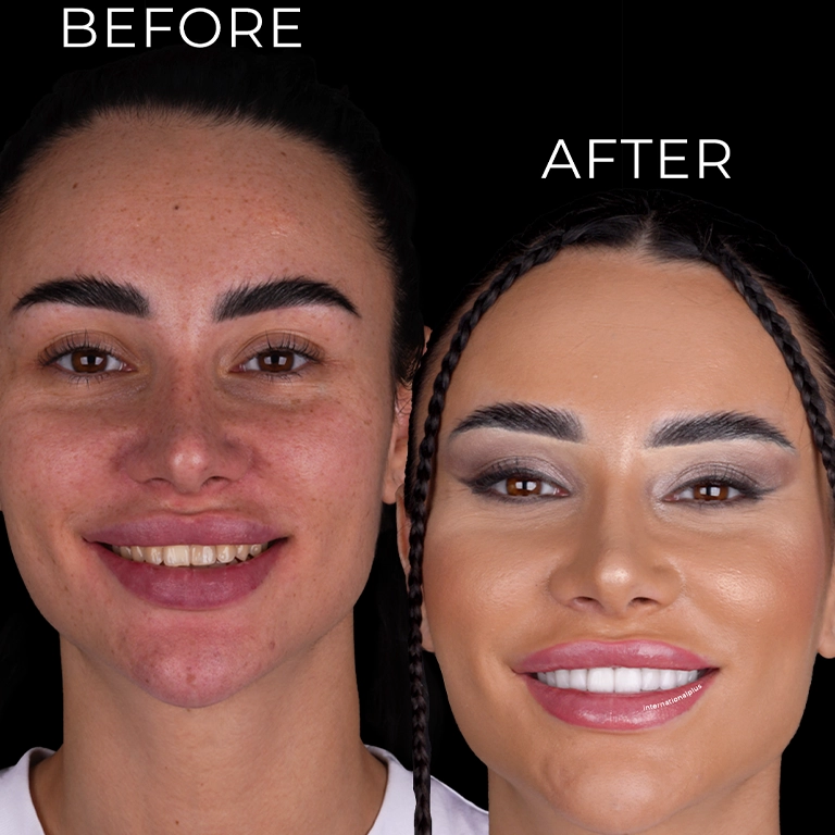 How Long Does Sensitivity Last After Veneers