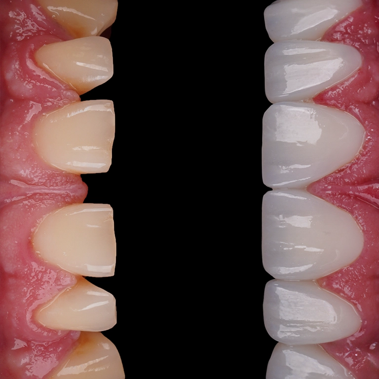How to Avoid Dental Implant Infection (Peri-implantitis)
