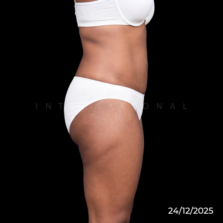 Immediate Skin Contraction with J-Plasma