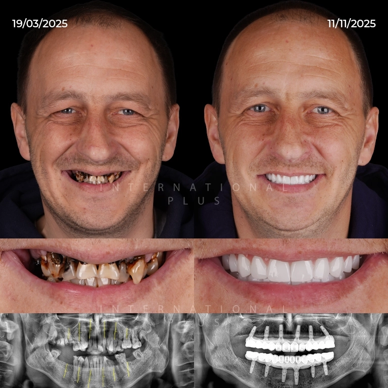 Is Dental Implant Pain Normal