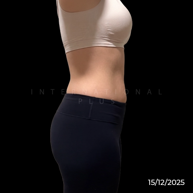 Long-Term Collagen Stimulation After Renuvion