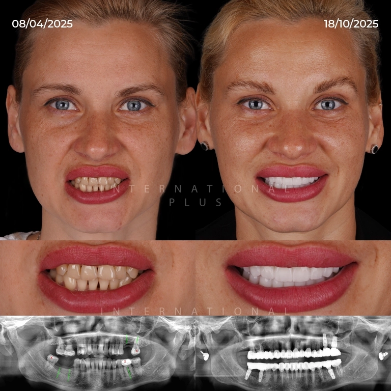 Managing Dental Implant Discomfort Day by Day