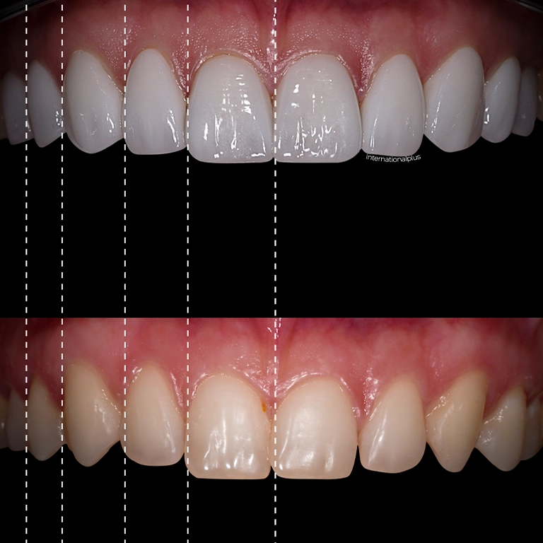 Managing Gum Tenderness and Bite Adjustment