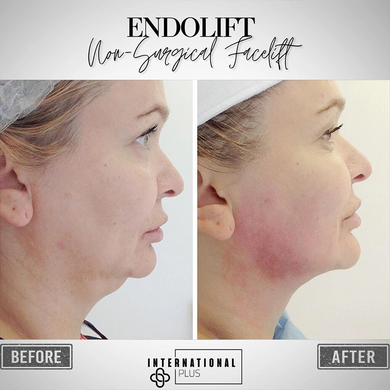 No-Scar Results How Endolift Fibers Heal Under the Skin