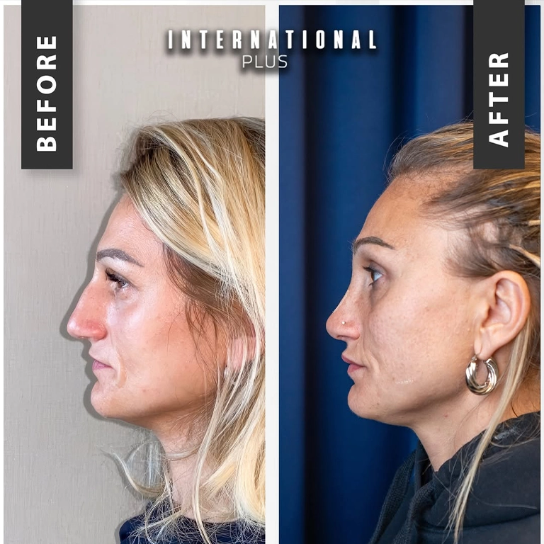Rhinoplasty Final Results When Does Swelling Fully Subside