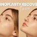 Rhinoplasty Recovery Timeline