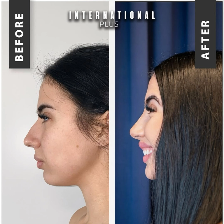 Rhinoplasty Recovery Timeline Day by Day