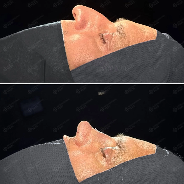Rhinoplasty Recovery What to Expect in the First 2 Weeks