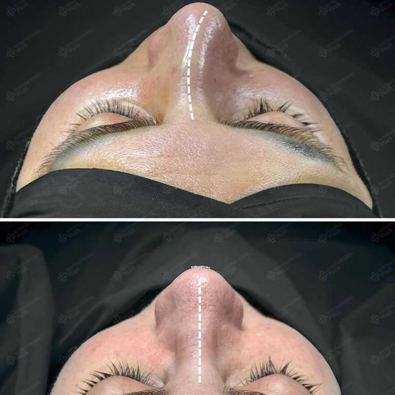 Rhinoplasty Splint Removal What Happens Next