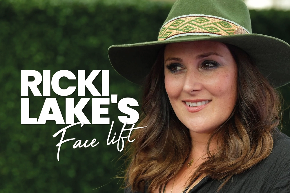 Ricki Lake Face Lift