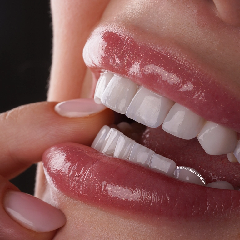 Veneers Before and After: The Final Look