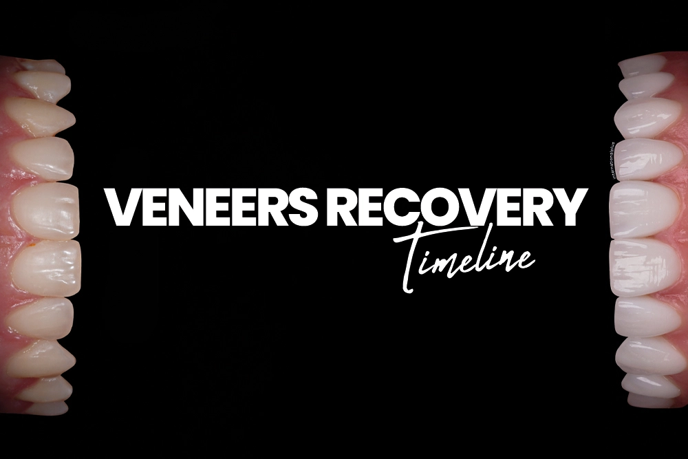 Veneers Recovery Timeline
