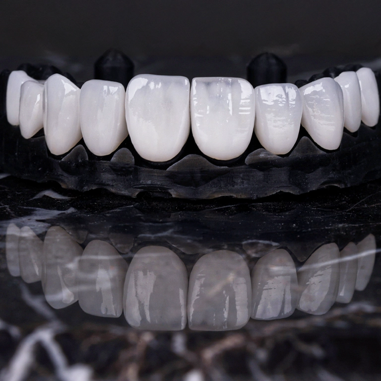 Veneers vs Bonding Cost and Value