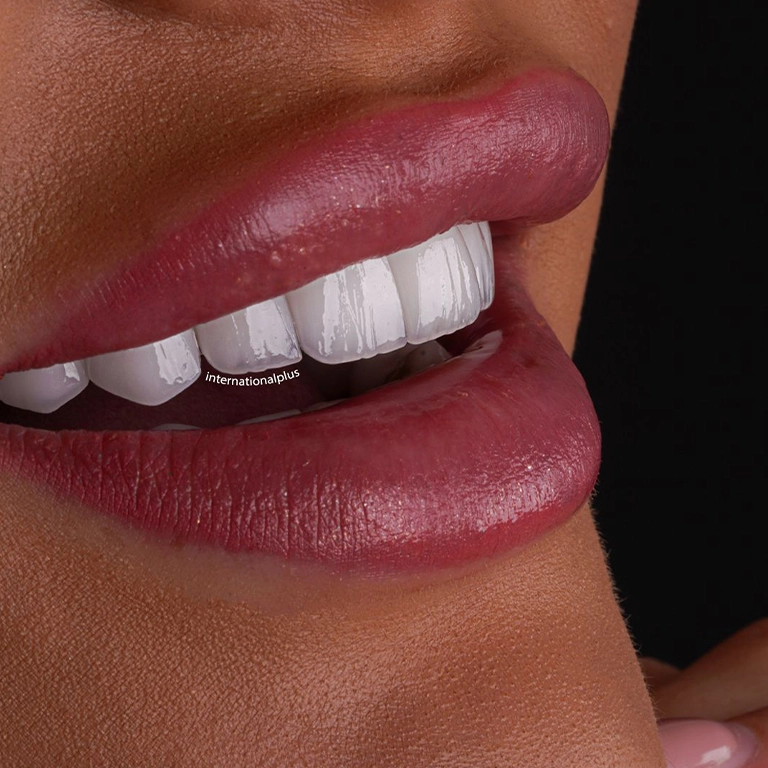 Veneers vs Bonding Longevity Comparison