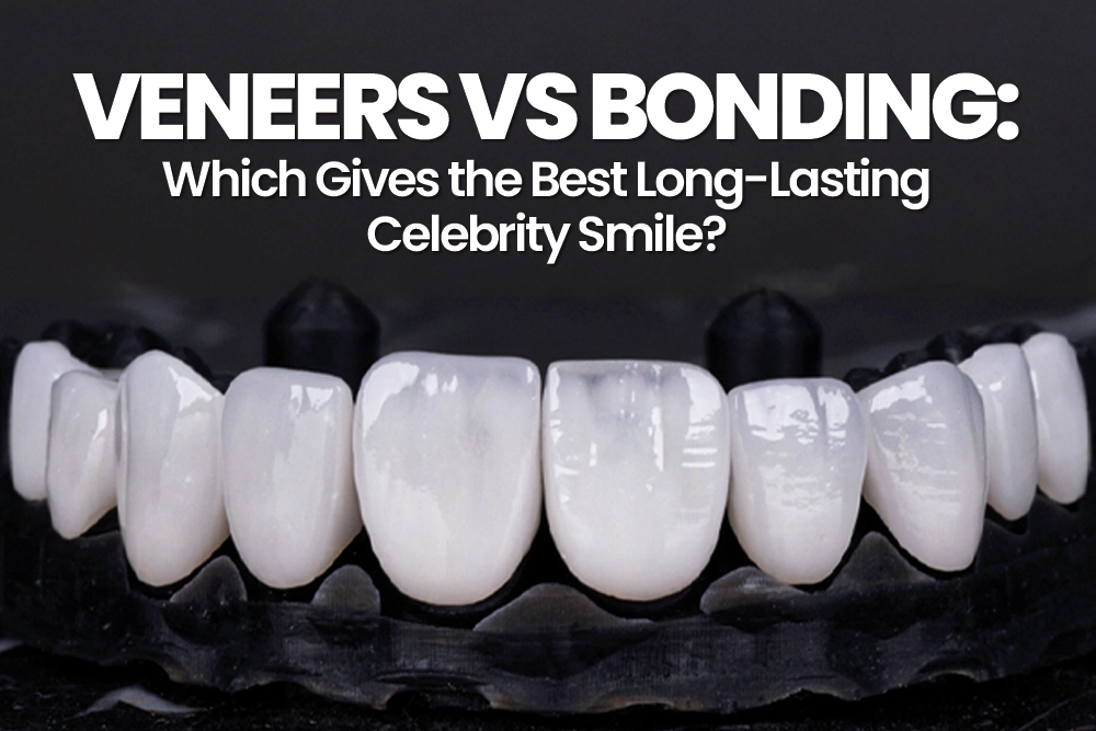 Veneers vs Bonding: Which Gives the Best Long-Lasting Celebrity Smile?