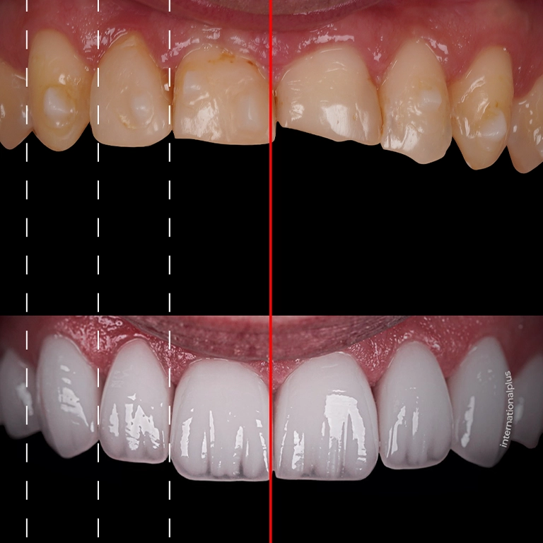 What to Expect After Veneers First 24-48 Hours