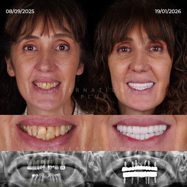 When to Call the Dentist After Implant Surgery