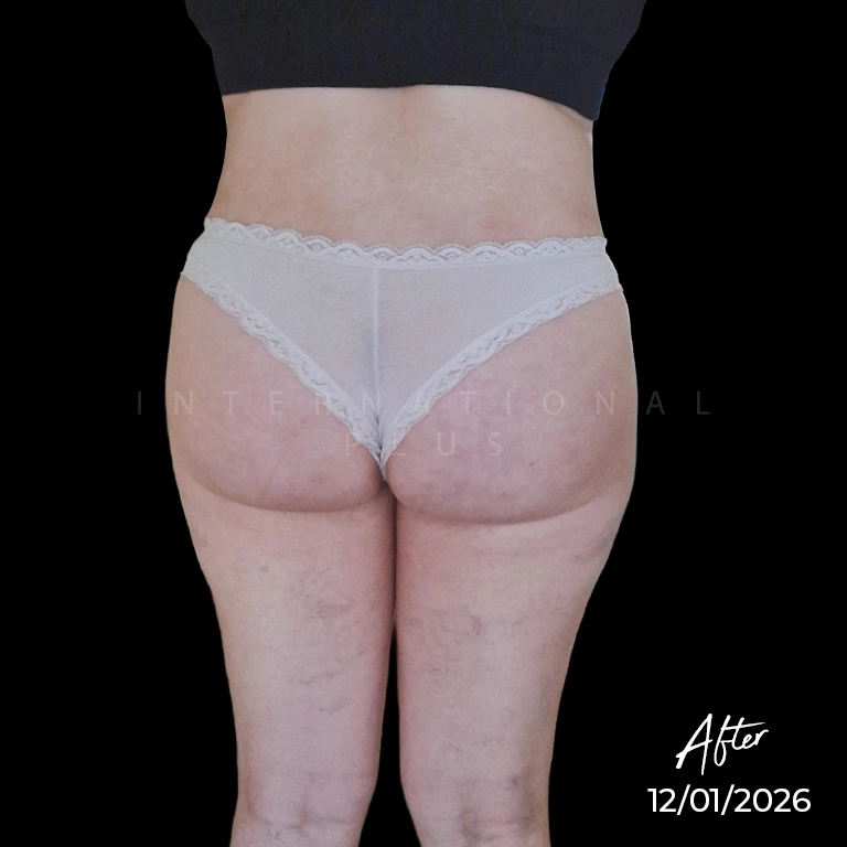 Why Some Fat is Reabsorbed After BBL