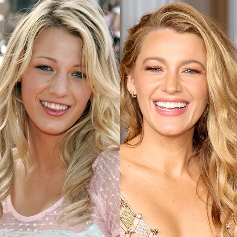 Blake Lively Before and After Photos The Gossip Girl Evolution