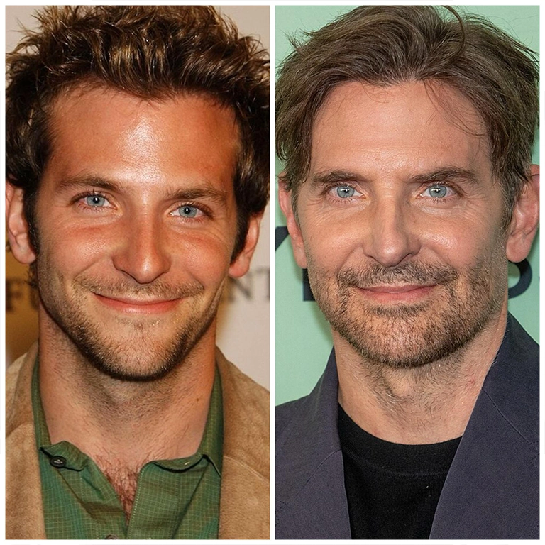 Bradley Cooper Eye Lift (Blepharoplasty) Analysis