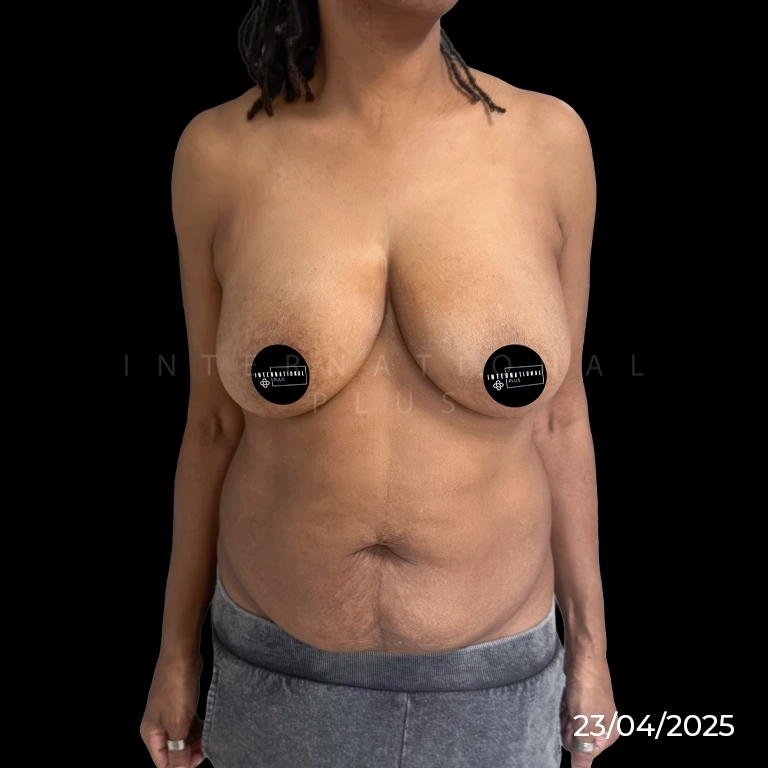Breast Lift with Implants Restoring Volume and Position
