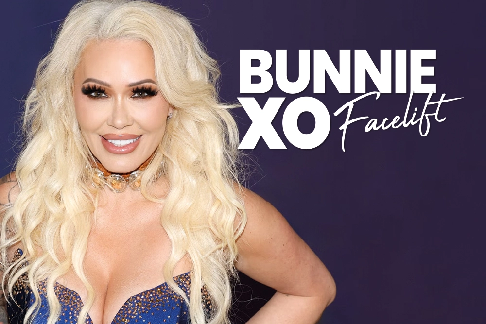 Bunnie Xo Facelift Before and After 2026: Radical Transparency in Aesthetics
