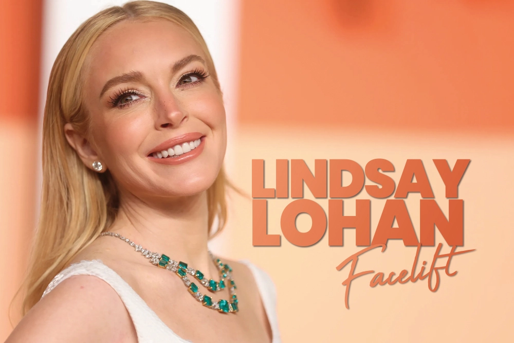 Lindsay Lohan Facelift